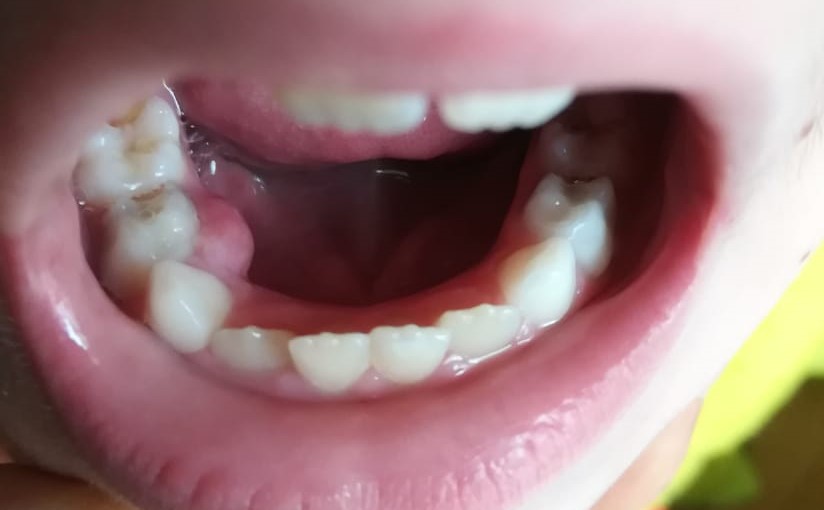 Absceso dental