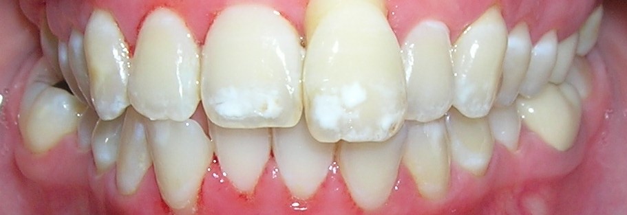 BB Hipoplasia IM