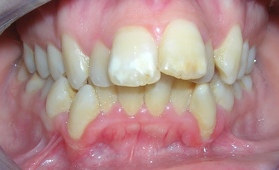 BC Hipoplasia