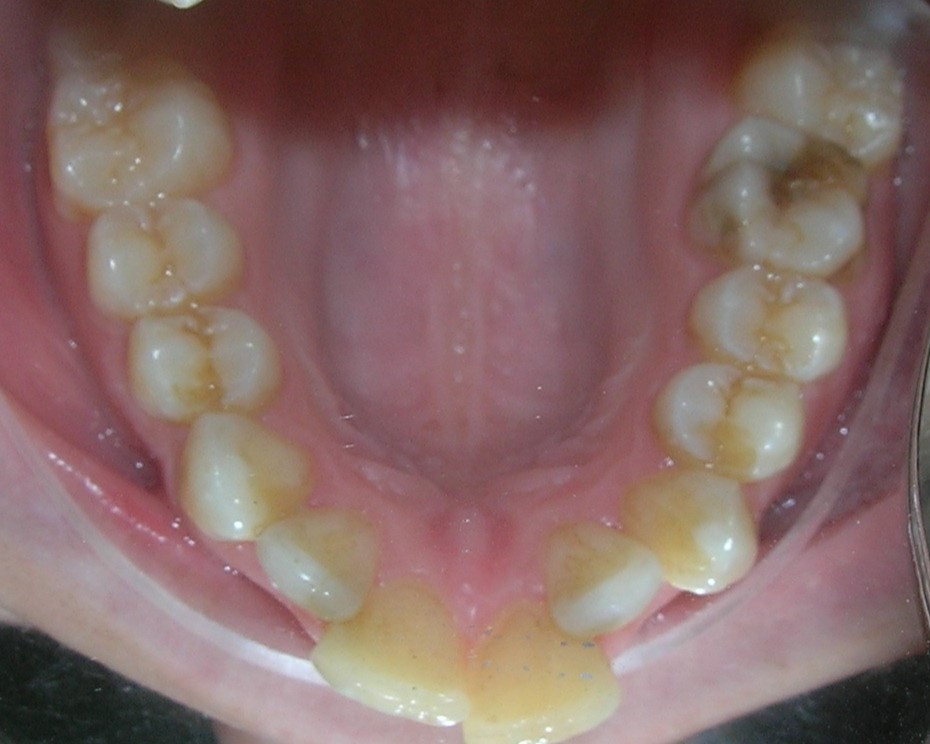 BC hipoplasia molar Max sup