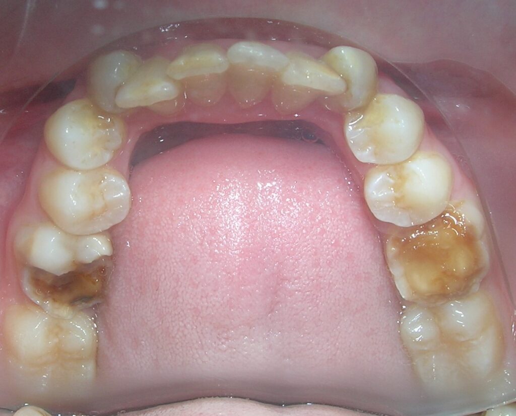 BC hipoplasia molar max inf