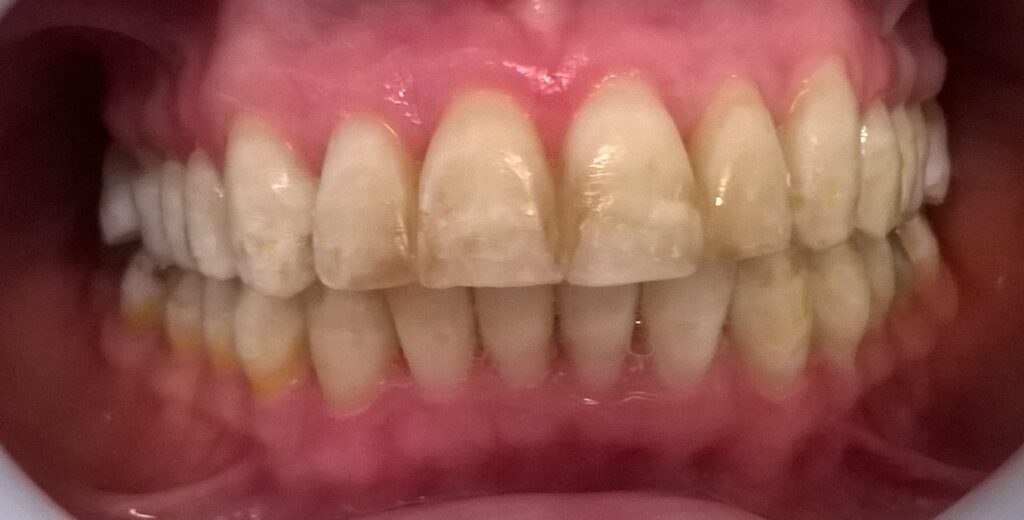 CD Hipoplasia