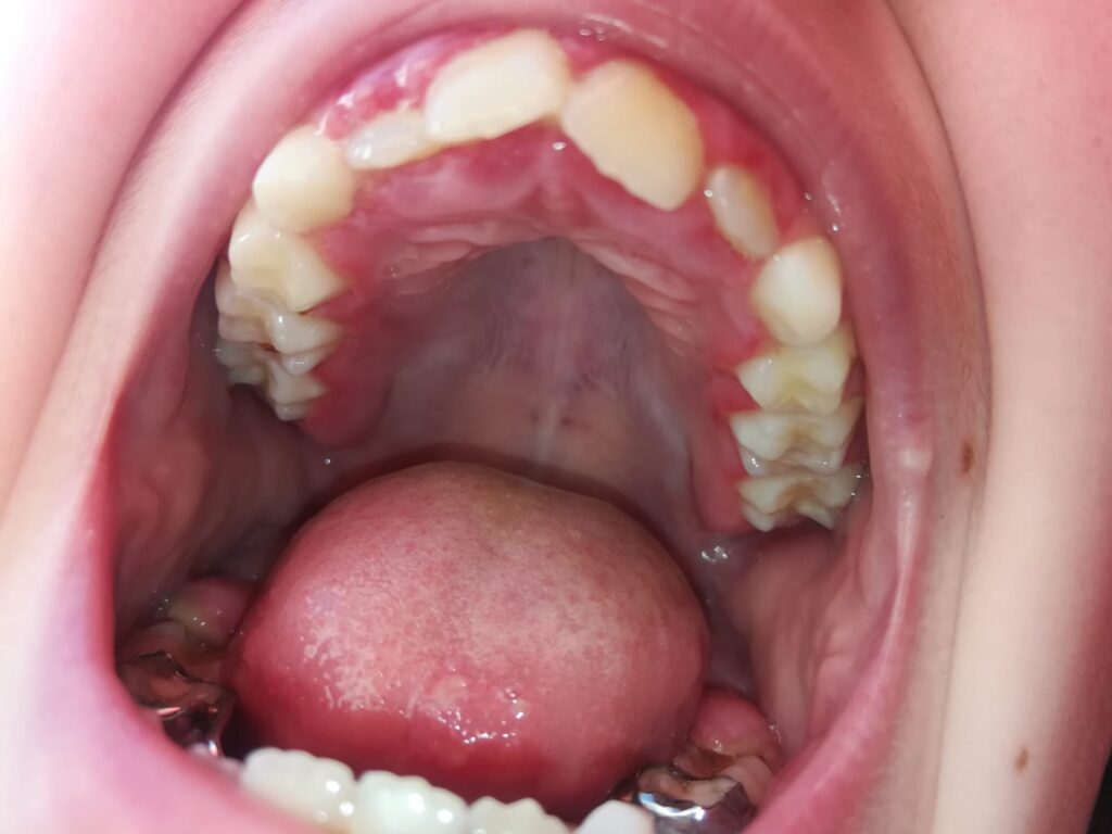 Gingivoestomatitis Herpética 1