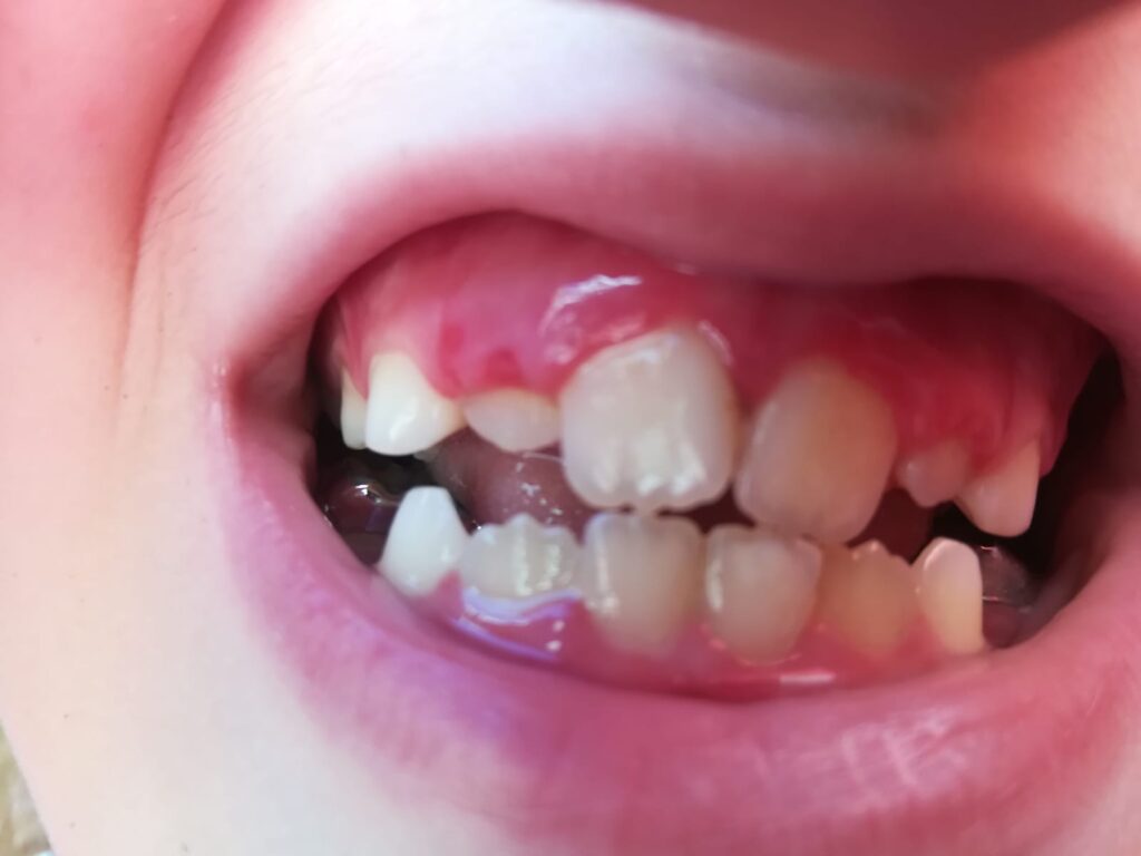 Gingivoestomatitis Herpetica 2